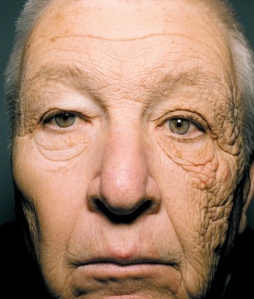 A truck driver whose left side was constantly exposed to sunlight shows how much it causes premature aging. 